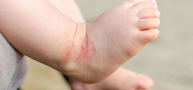 Атопический дерматит у детей. Современный подход к лечению