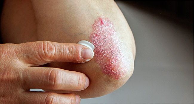 Сухая кожа тела – Причины, симптомы и решения