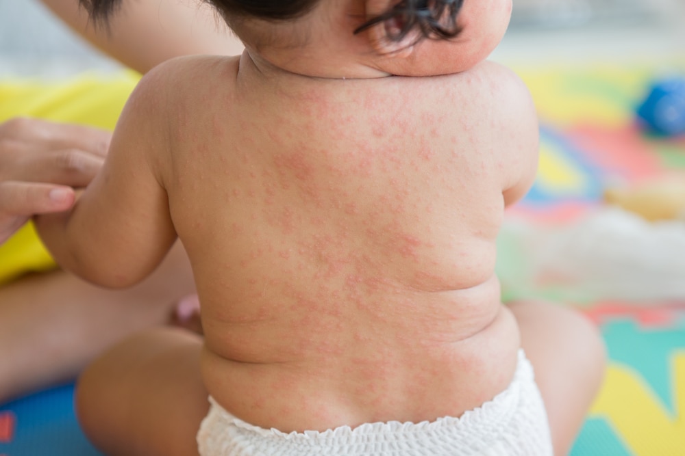 6 детских болезней с сыпью: как не запаниковать и не пропустить серьезное